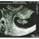 Ultrasound image of baby 3